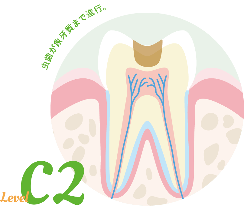 象牙質の虫歯